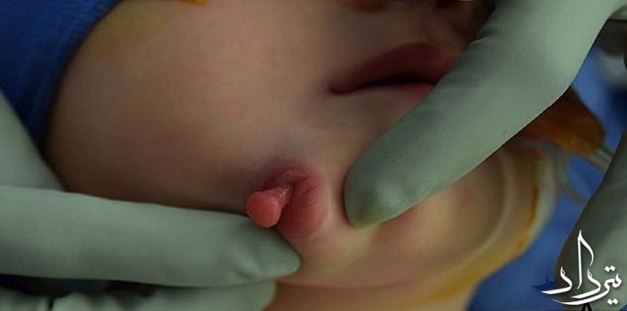 تولد نوزادی با دو دهان در آمریکا