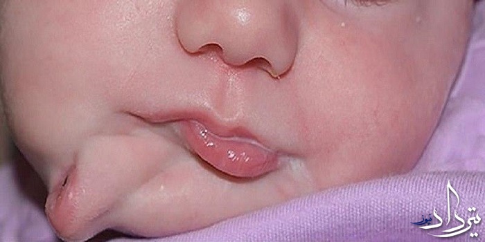 تولد نوزادی با دو دهان در آمریکا